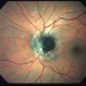 Melanocytoma
